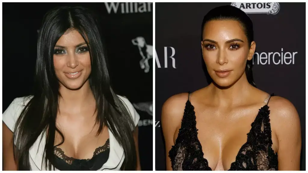 plastic-surgery-botox-kim-kardashian